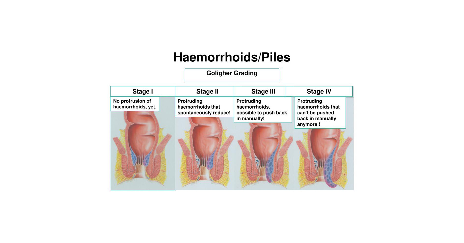 Haemorrhoids With Dr Thomas Suhardja