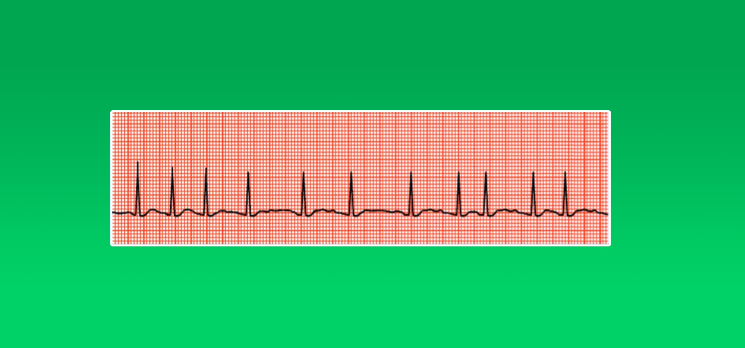 Cardiac Stress Test