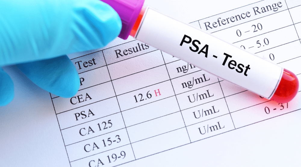 PSA Blood Test