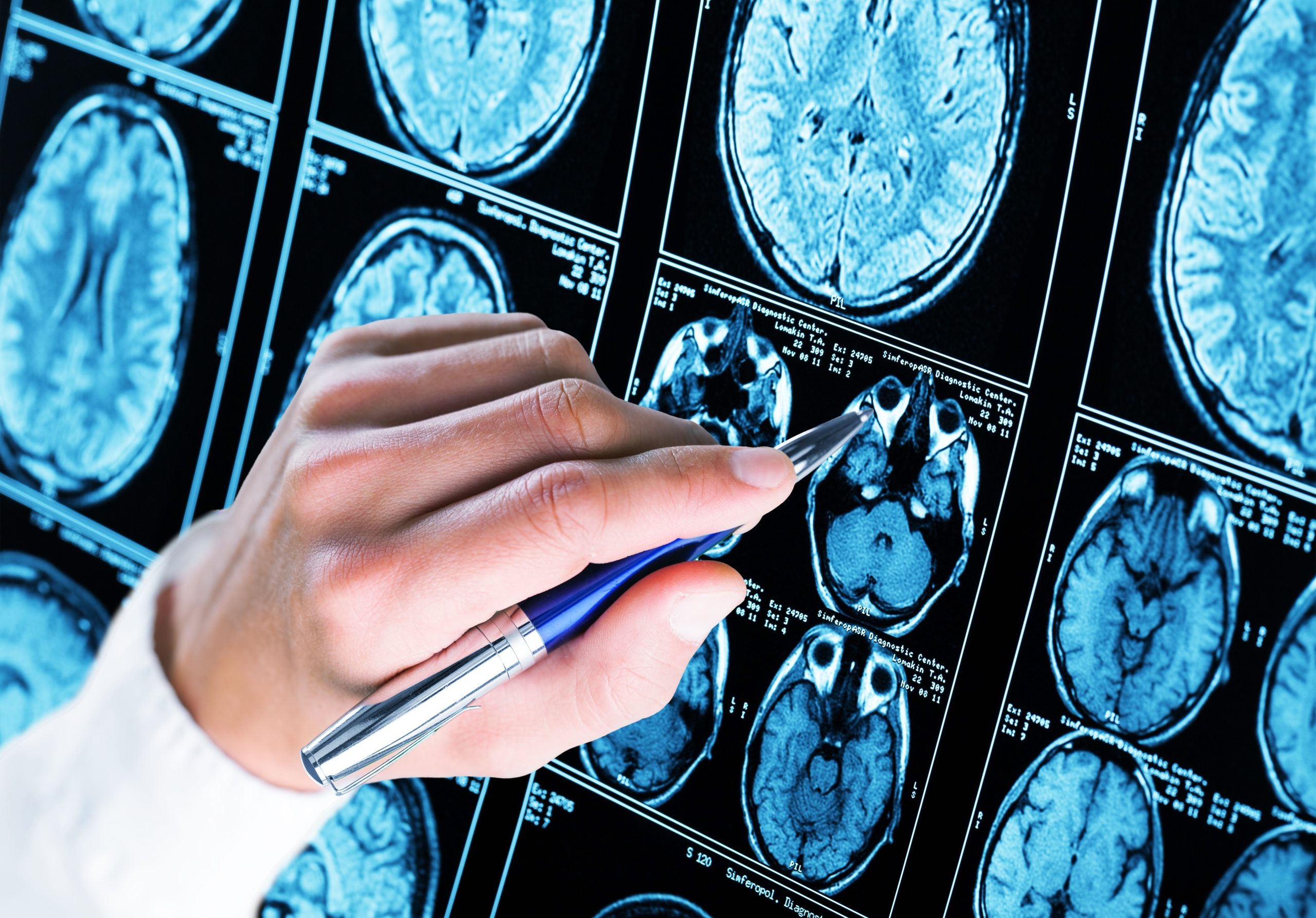 Australia Just Approved a New Alzheimer’s Treatment